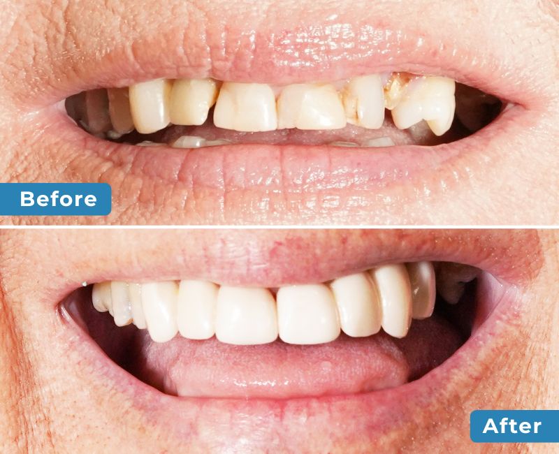 Smile Transformation 1