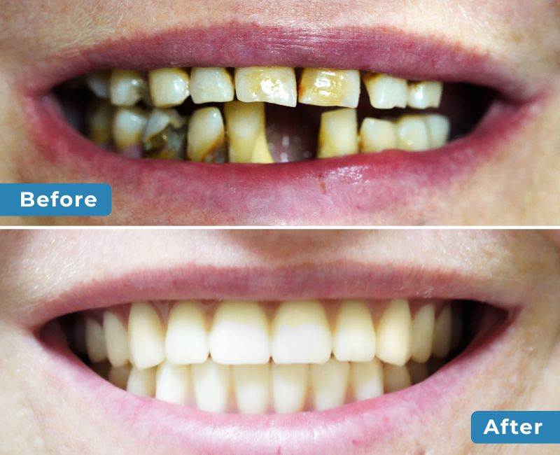 Smile Transformation 2